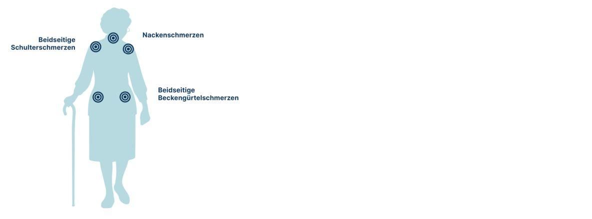 Bei Polymyalgia rheumatica treten häufig Nackenschmerzen, beidseitige Schulterschmerzen und beidseitige Beckengürtelschmerzen auf